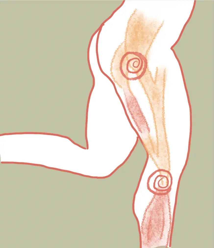 髂脛束綜合症 (IT Band Syndrome)
